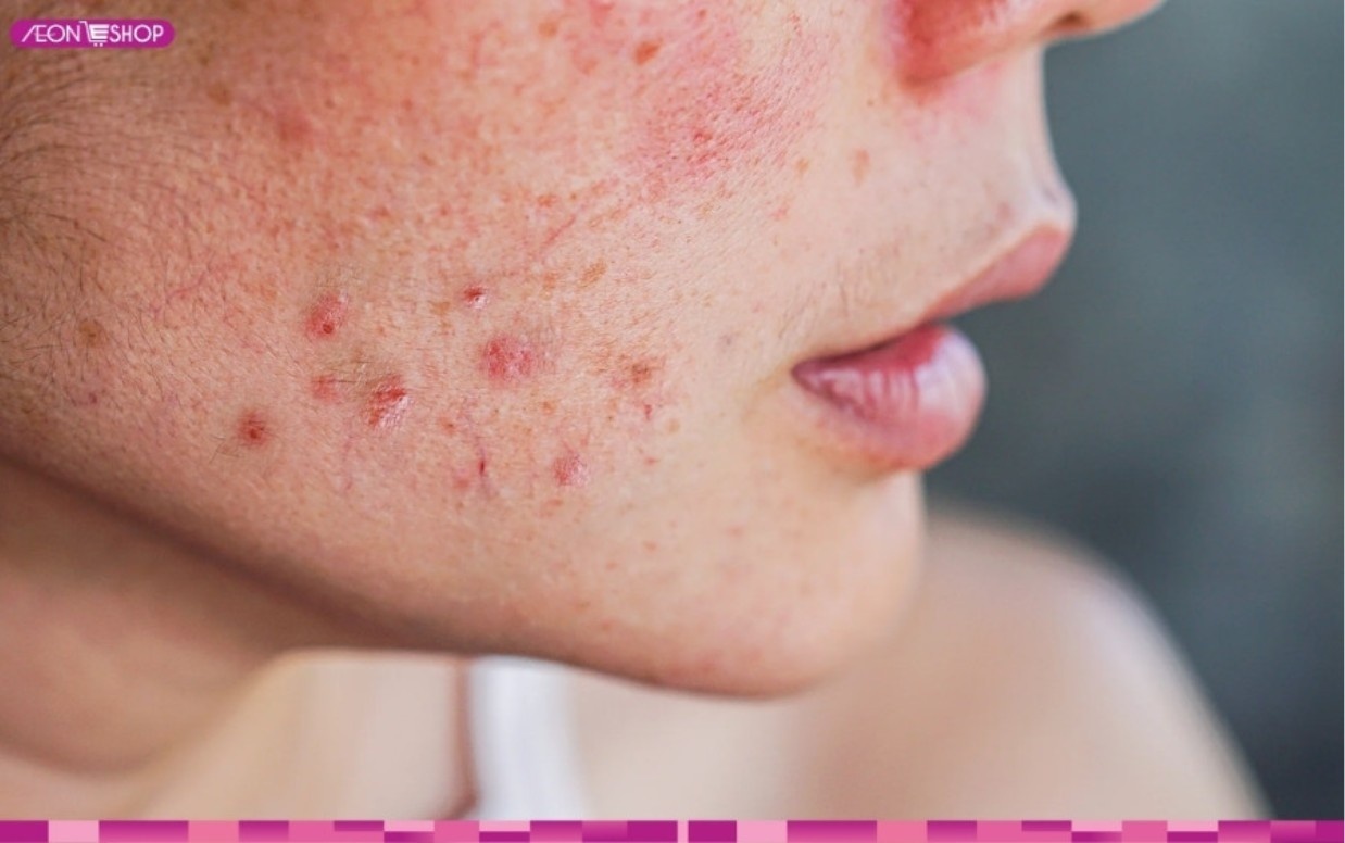 Da mụn rất dễ bị kích ứng và tổn thương